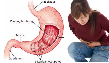 asam lambung