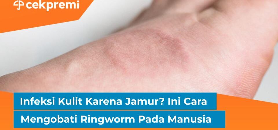 cara mengobati ringworm pada manusia