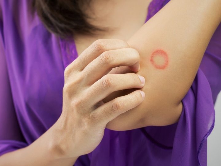 cara mengobati ringworm pada manusia