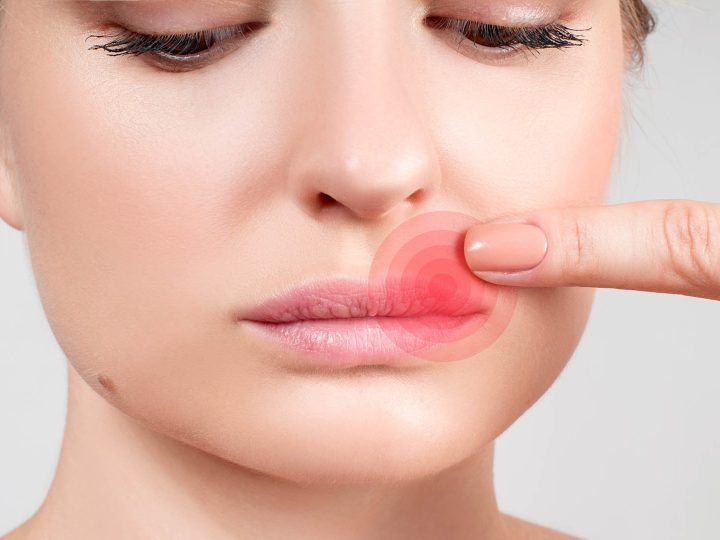 cara menyembuhkan herpes