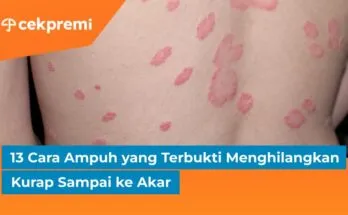 13 Cara Ampuh yang Terbukti Menghilangkan Kurap Sampai ke Akar 1 Thumbnail Artikel CP 2024 08 22T111632.274